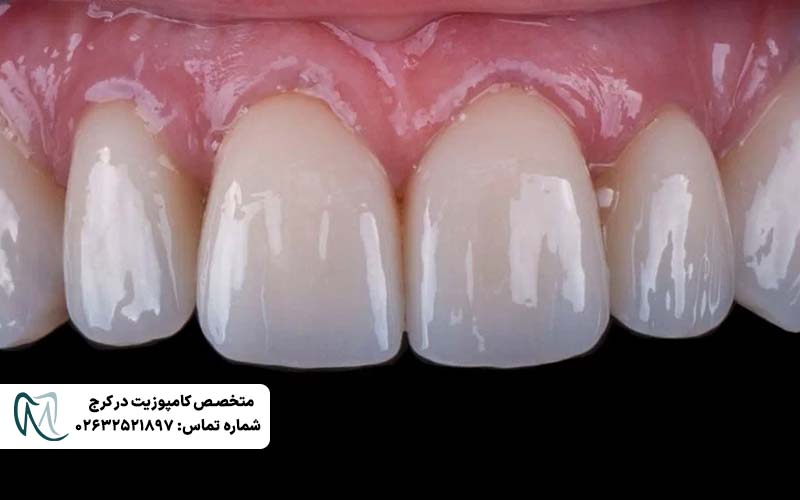 لمینت لومینیرز دندان