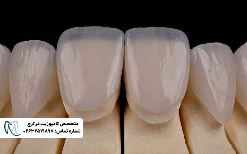 کامپوزیت ونیر لبه شفاف