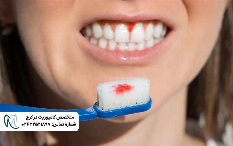خونریزی لثه
