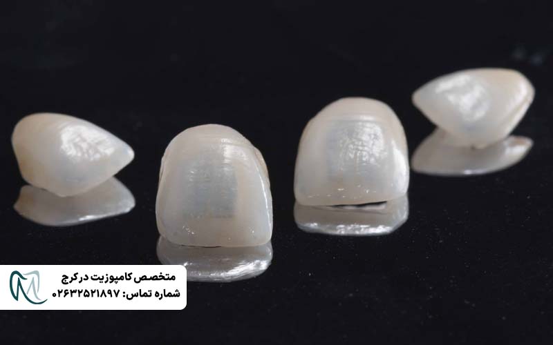 کامپوزیت ونیر لبه شفاف