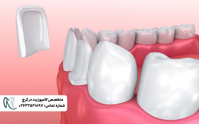 کامپوزیت ونیر لبه شفاف