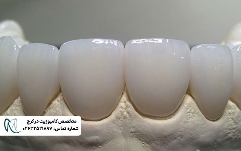 کامپوزیت ونیر لبه شفاف