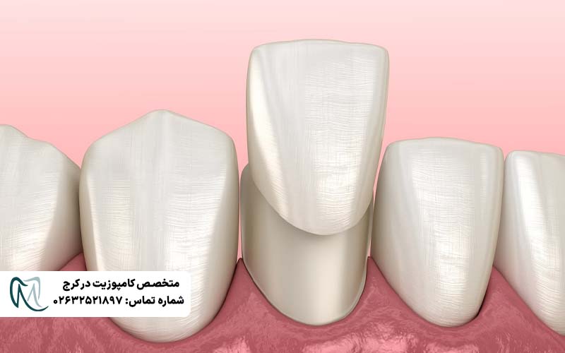 کامپوزیت ونیر لبه شفاف