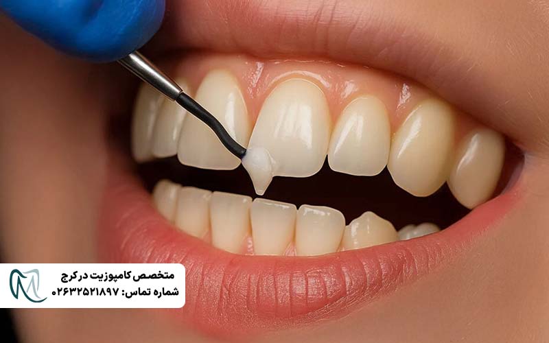 علت سیاه شدن کامپوزیت دندان