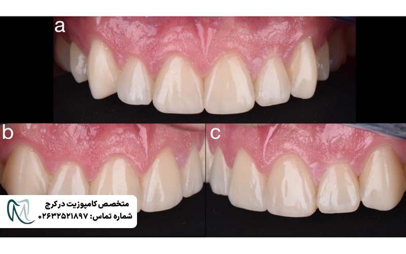 علت سیاه شدن کامپوزیت دندان
