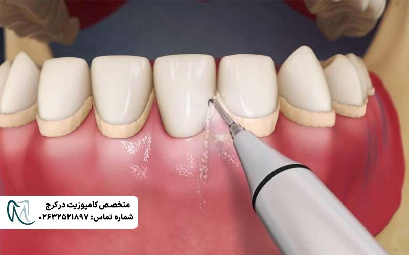 علت سیاه شدن کامپوزیت دندان