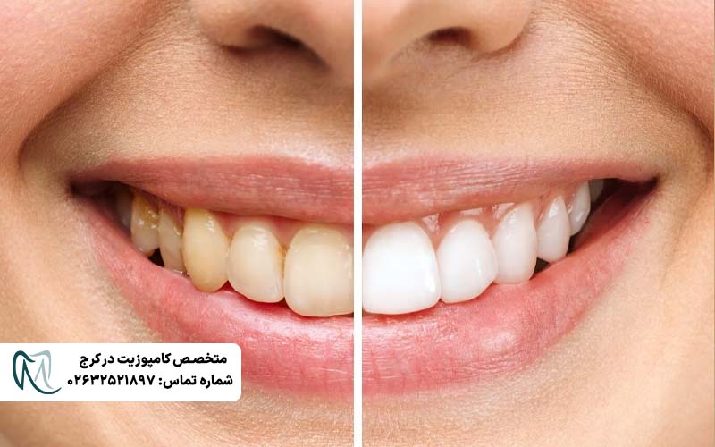 علت سیاه شدن کامپوزیت دندان