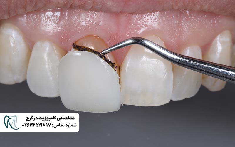 علت سیاه شدن کامپوزیت دندان