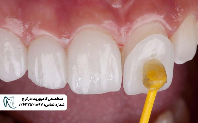 علت سیاه شدن کامپوزیت دندان