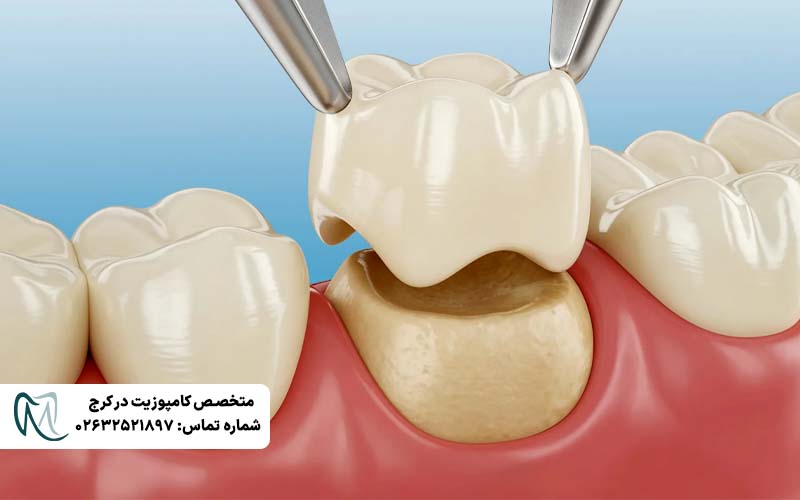 تفاوت روکش زیرکونیا و PFM