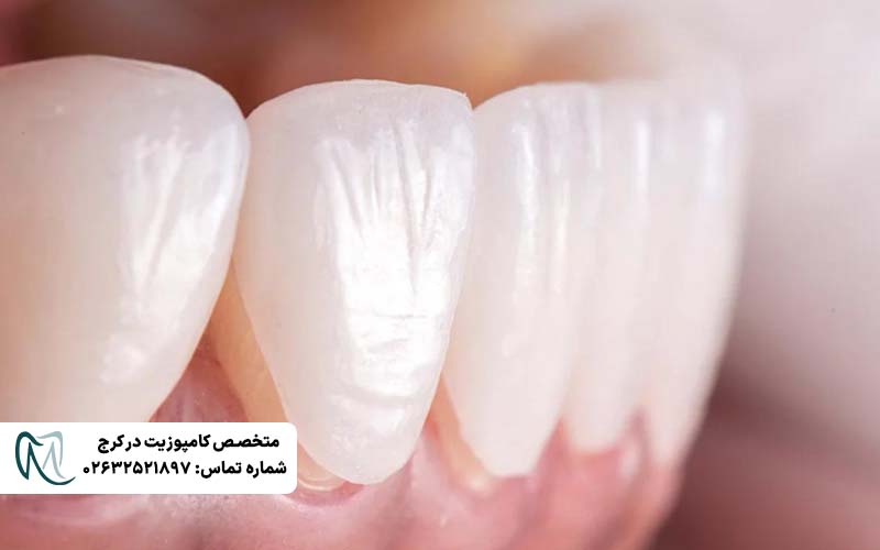 انواع لمینت دندان