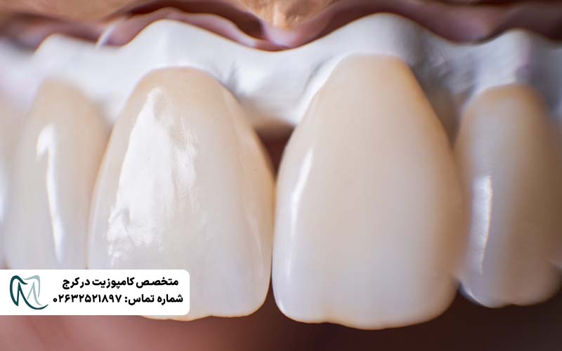 لمینت دندان بدون تراش