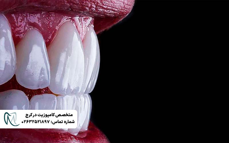 انواع لمینت دندان