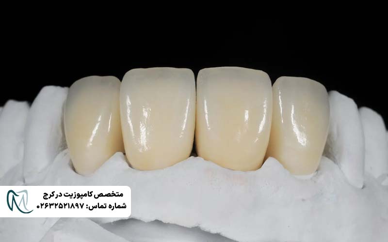 تفاوت روکش زیرکونیا و PFM