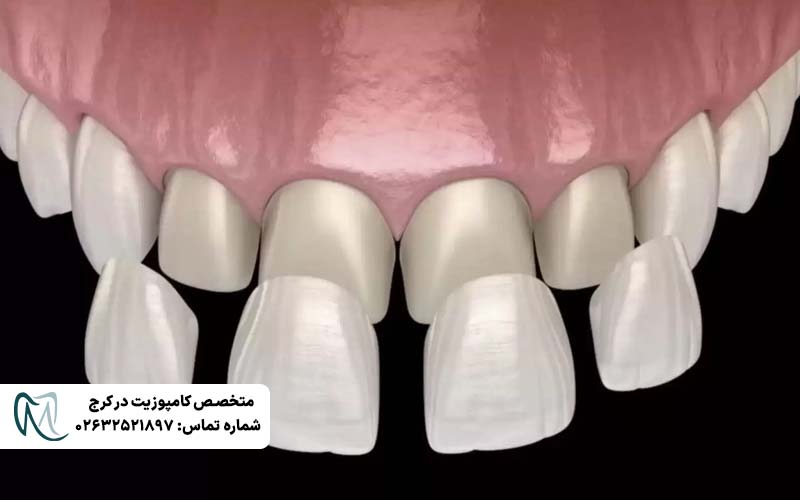 لمینت دندان بدون تراش
