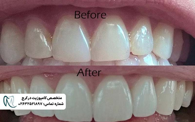 انواع لمینت دندان