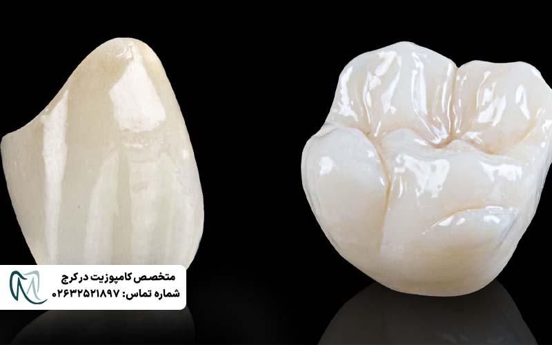 تفاوت روکش زیرکونیا و PFM