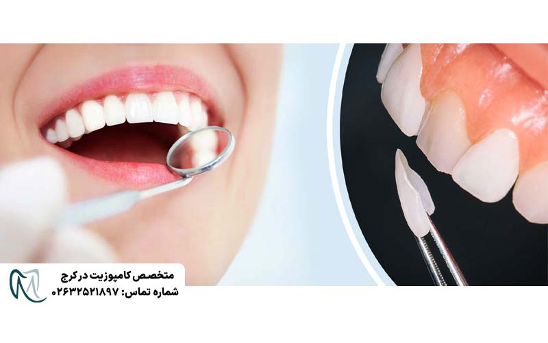 لمینت دندان بدون تراش