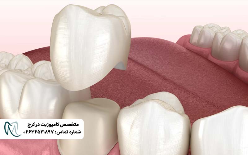تفاوت روکش زیرکونیا و PFM