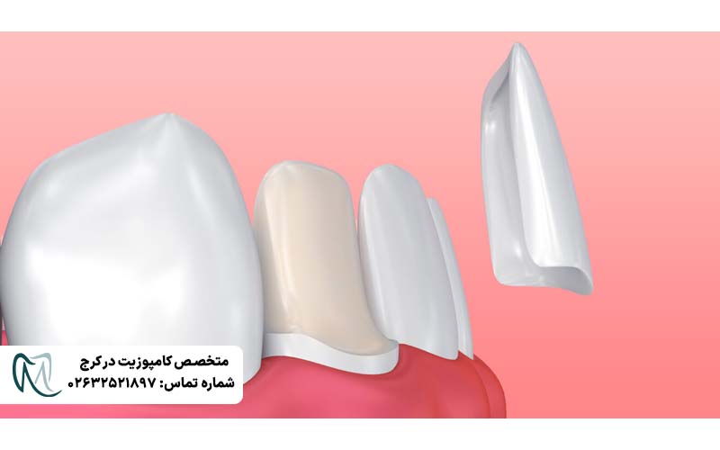 لمینت دندان بدون تراش