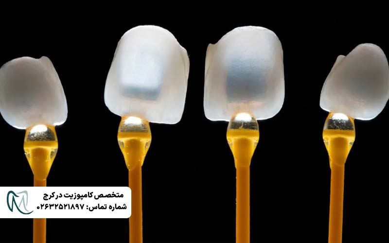 انواع لمینت دندان