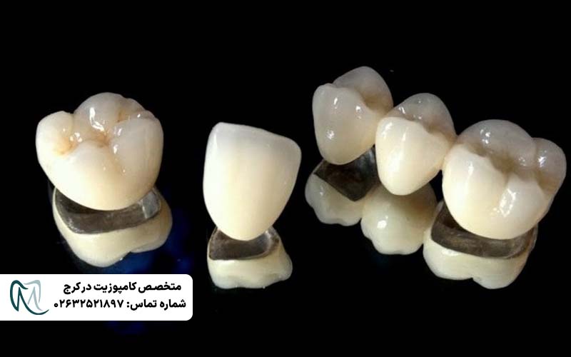 تفاوت روکش زیرکونیا و PFM