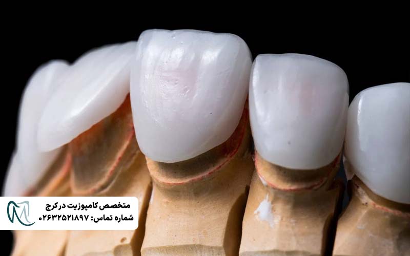 انواع لمینت دندان