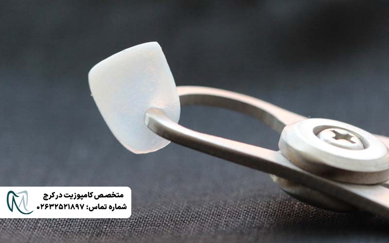 انواع لمینت دندان