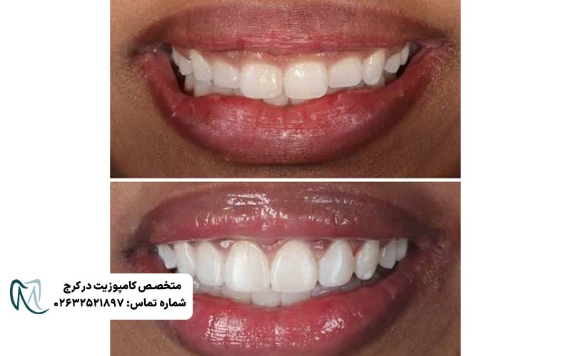 لیفت لثه برای کامپوزیت