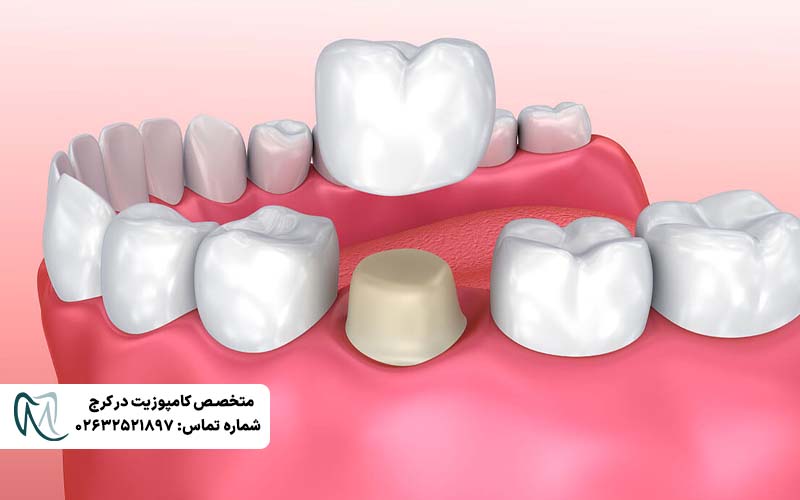 دلایل کنده شدن روکش دندان