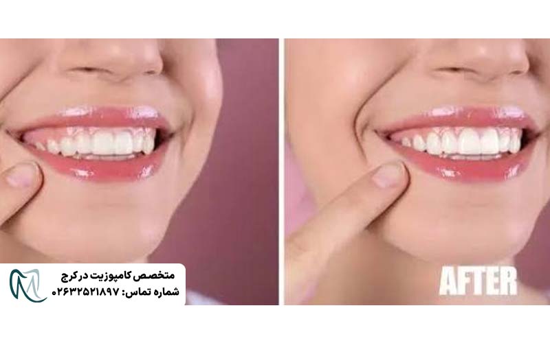 لیفت لثه برای کامپوزیت