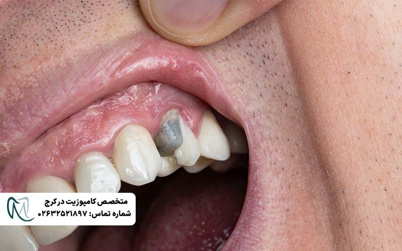 دلایل کنده شدن روکش دندان