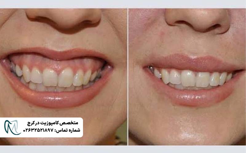 لیفت لثه برای کامپوزیت