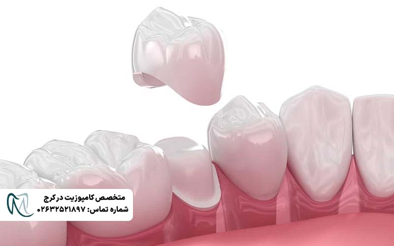 دلایل کنده شدن روکش دندان