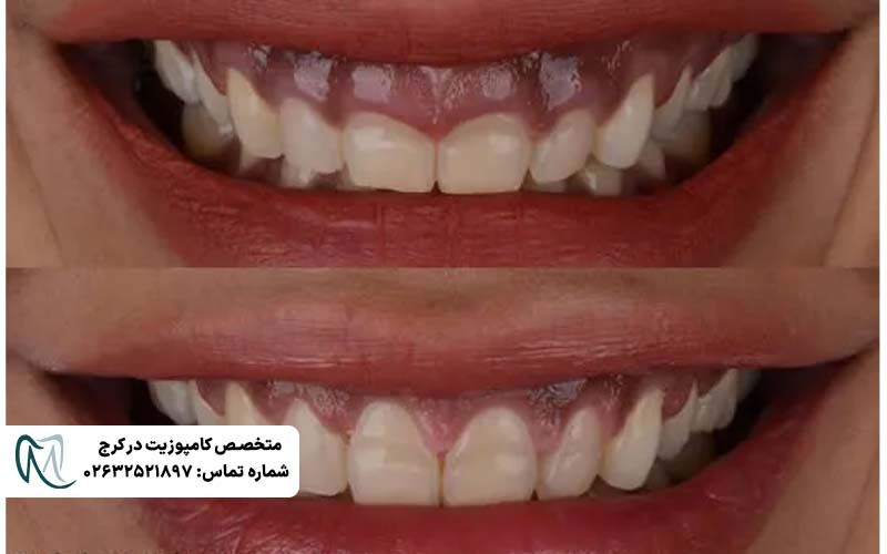 لیفت لثه برای کامپوزیت