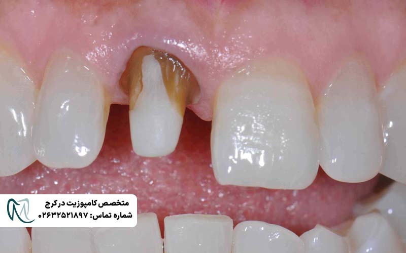 دلایل کنده شدن روکش دندان