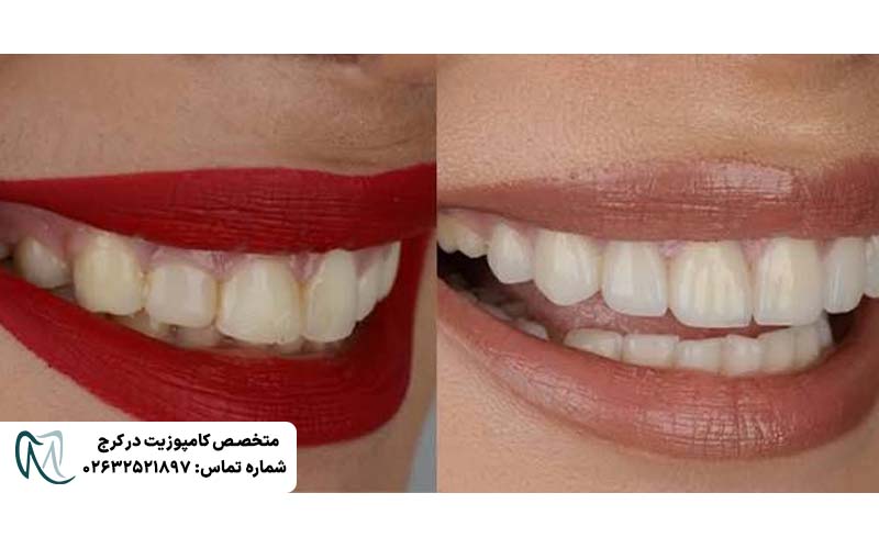 لیفت لثه برای کامپوزیت