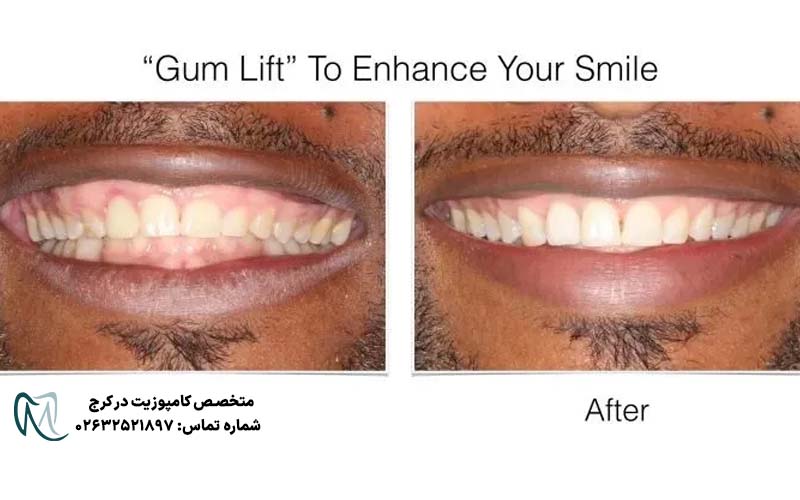لیفت لثه برای کامپوزیت