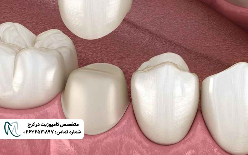 دلایل کنده شدن روکش دندان